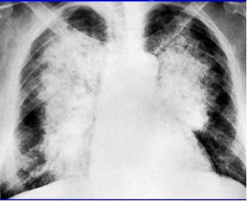 蝶翼征是间质性肺水肿的表现吗,肺蝶翼征