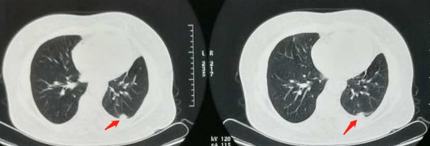 癌症靶向药治疗一年费用是多少,免疫加靶向治疗癌症几次能见效