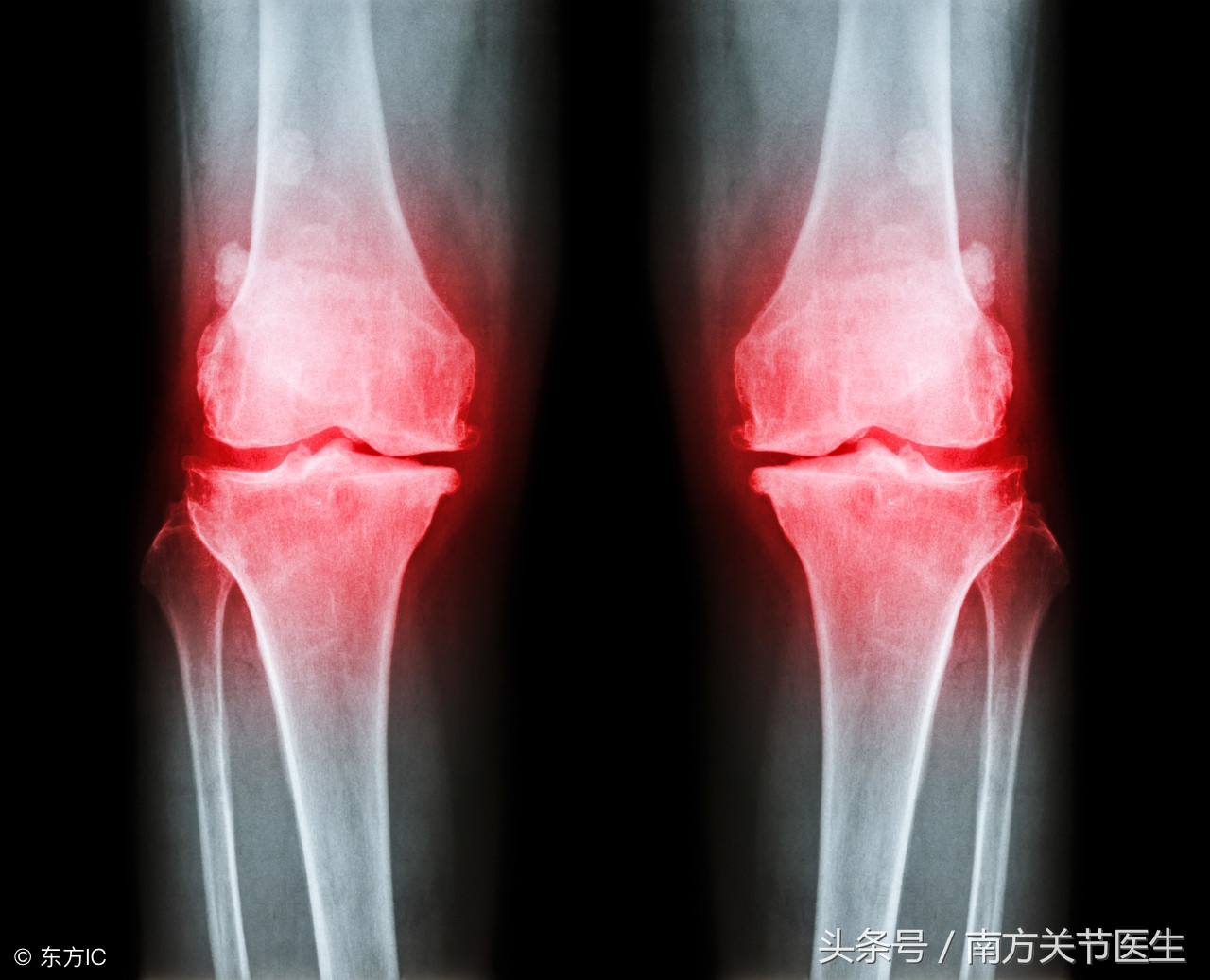 骨质增生可以做手术吗效果怎么样,颈椎骨质增生的手术治疗风险大吗