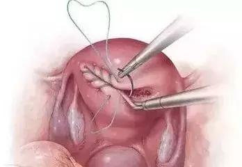 无痛人流是真的一点感觉都没有吗,无痛人流安全吗会不会造成不孕