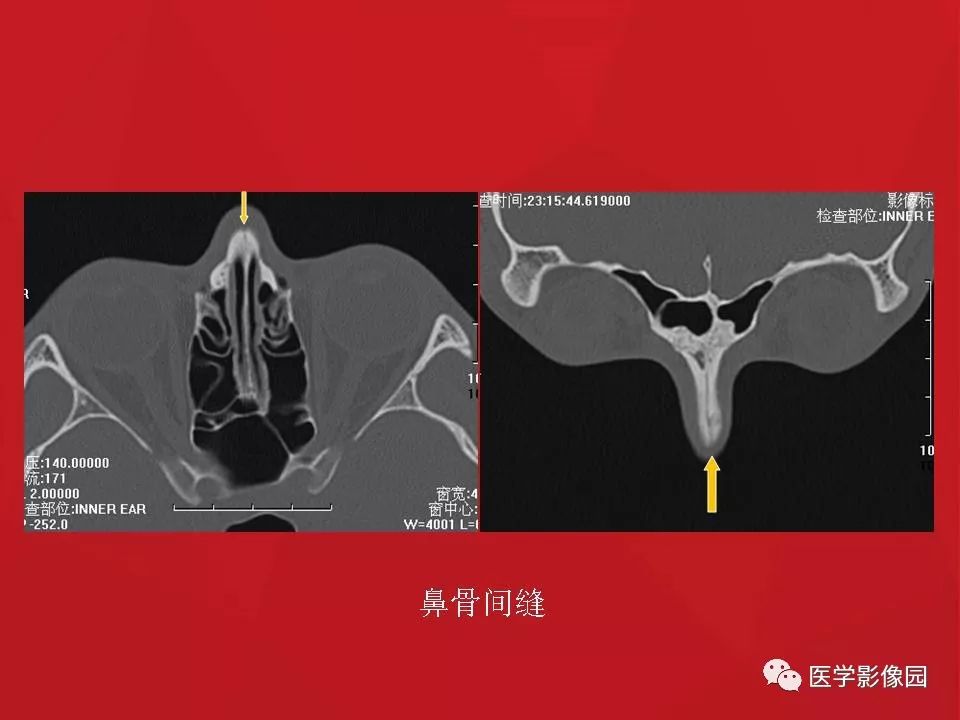左侧鼻骨骨折伴鼻中隔骨折,双侧鼻骨及左上颌骨突骨折