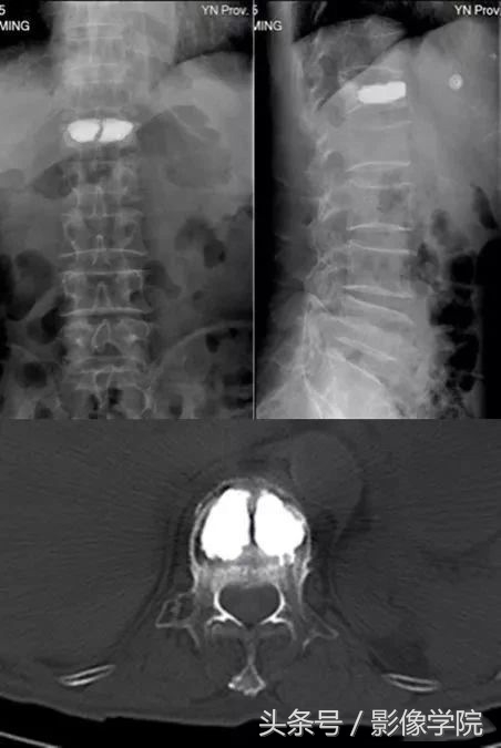 骨质疏松引起的老年性腰椎骨折,胸11椎体压缩性骨折怎么治疗