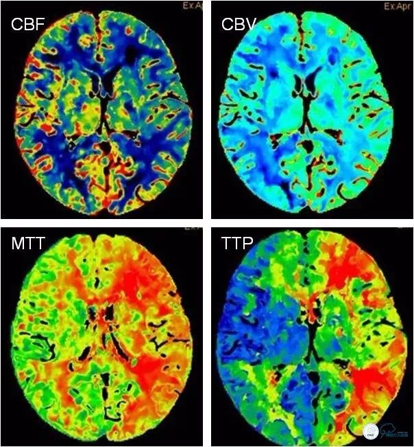 大脑中动脉支架术后再狭窄的几率,天坛医院介入脑血管手术