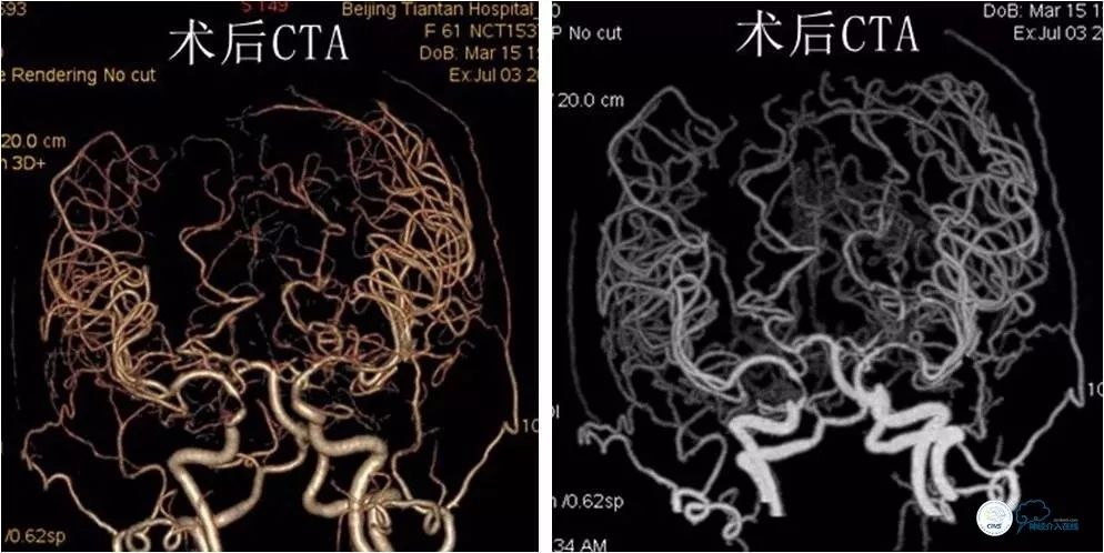 大脑中动脉支架术后再狭窄的几率,天坛医院介入脑血管手术