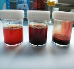 肺癌合并肺纤维化治疗,肺栓塞患者合并肺癌