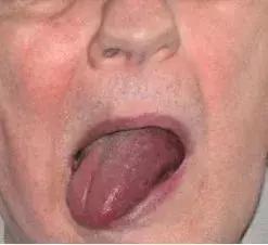舌头出现这四种情况需要注意,舌头这3种表现多半是身体在报警