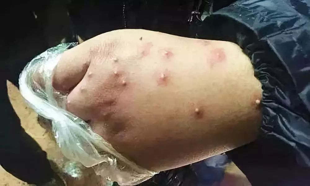 小心“新型艾滋病”，虫子就能传播