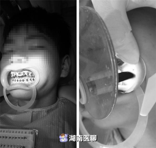 7岁孩子牙齿正畸的真实感受,牙套的诱惑