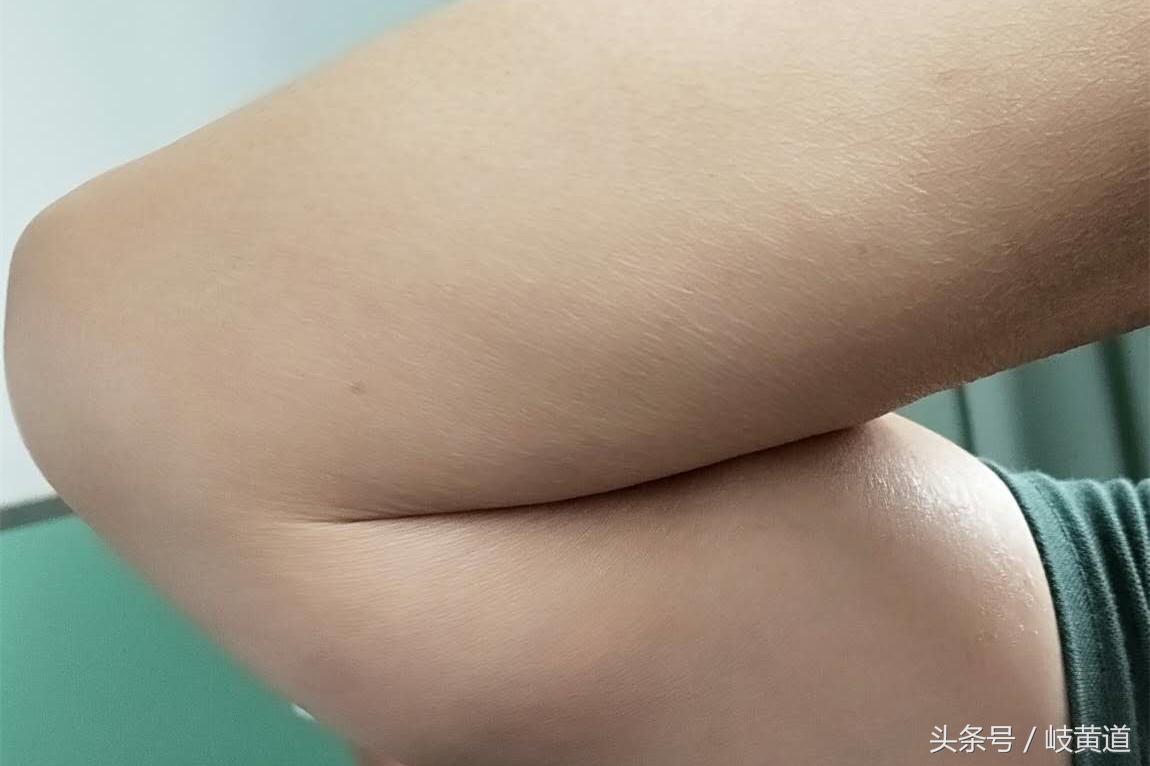 女性胳膊窝有个大包怎么回事,胳膊上突然多了一个肿包