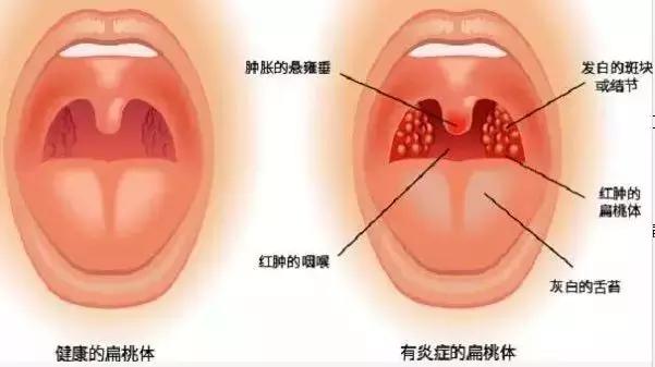 小孩经常扁桃体发炎发烧能切除吗,孩子喉咙老发炎引起发烧