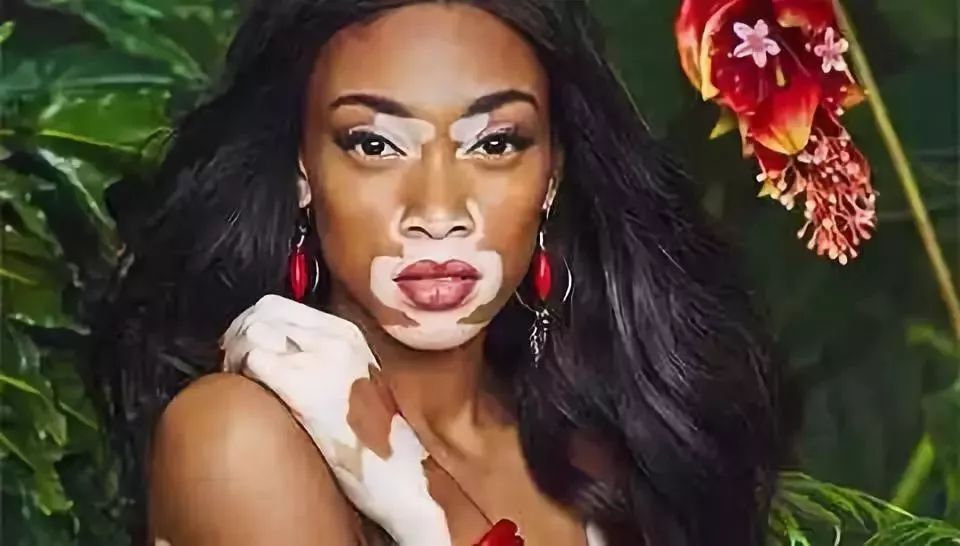 直播治疗白癜风最新特效药,白癜风治疗视频直播