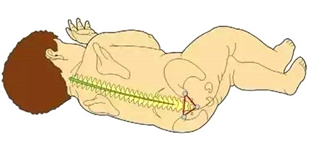 宝宝出生腰骶部有小洞可能是脊柱裂