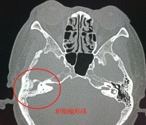 孩子急性中耳炎听力下降,中耳炎导致的听力下降可以恢复吗