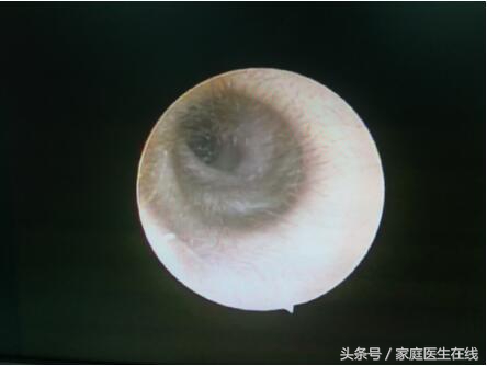耳朵里掏异物,孩子耳朵进了东西怎么解决