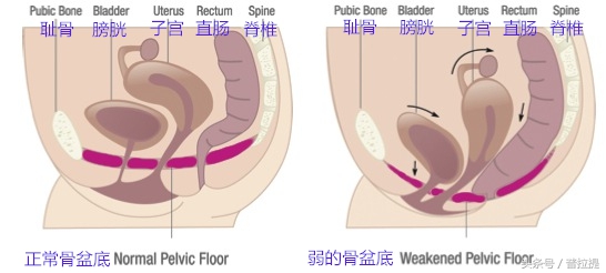 腰背不舒服，漏尿等都是骨盆底肌惹的祸，用普拉提来锻炼他吧！