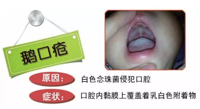 新生儿鹅口疮原因是什么,新生儿鹅口疮引起的原因是什么