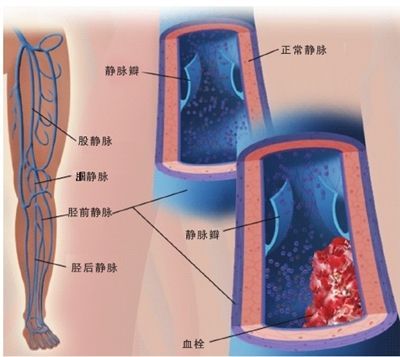 怀孕四个月血栓高怎么办,怀孕后如何预防血栓的发生