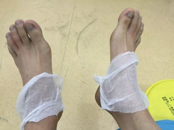 在广西被小虫子咬了怎么处理,广西女子被红蚂蚁咬后身亡