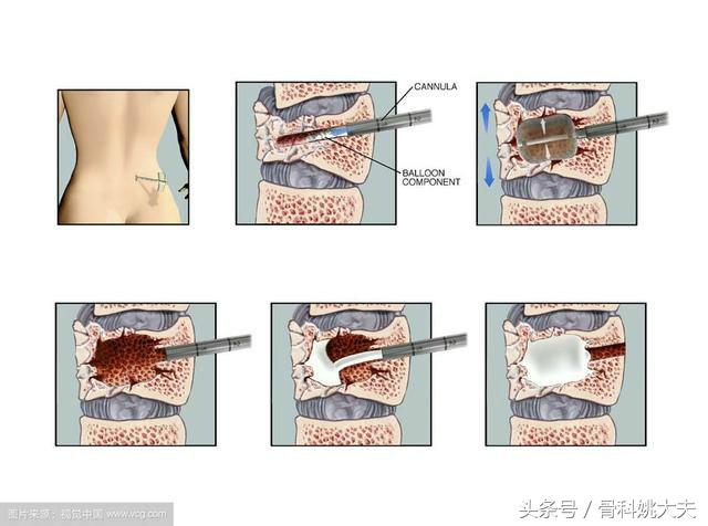 骨折了疼痛难忍怎么办,骨折处疼痛怎么减轻