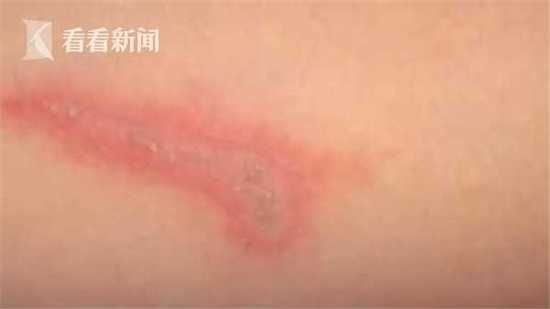 被蚂蚁咬导致死亡,男子被红蚁咬了开车去医院