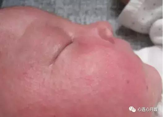 痱子和湿疹怎么区别,痱子和湿疹摸起来有什么区别