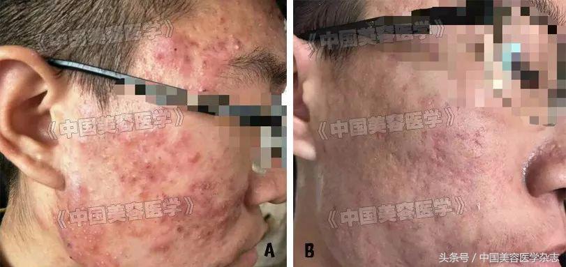 面部痤疮有什么危害,严重性痤疮要注意什么