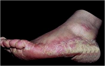 手足癣治病步骤,手足癣用什么药治疗好