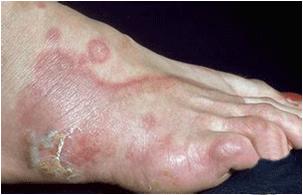 手足癣治病步骤,手足癣用什么药治疗好