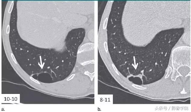 肺结节14种影像,一百例有结果的肺结节影像分析