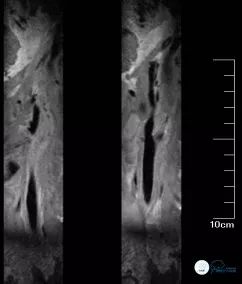颈动脉闭塞介入治疗的风险,慢性动脉闭塞症病例