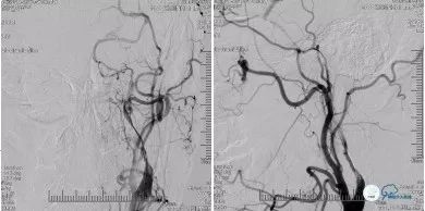 颈动脉闭塞介入治疗的风险,慢性动脉闭塞症病例