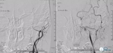 颈动脉闭塞介入治疗的风险,慢性动脉闭塞症病例
