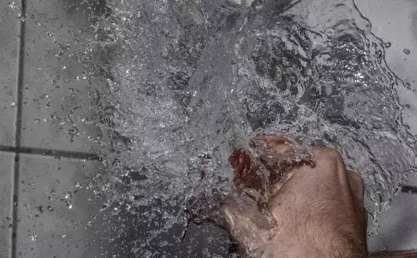 在家身上被开水烫伤后怎么急救,儿童开水烫伤急救处理