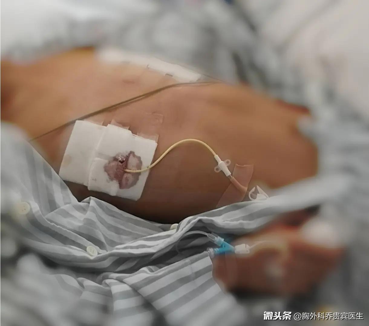 漏斗胸男怎么自己矫正,成年人漏斗胸保守治疗方法