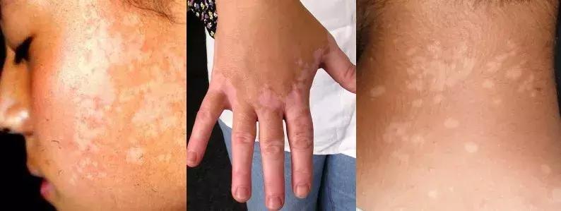 宝宝脸上长了白斑,是不是肚子里有蛔虫?