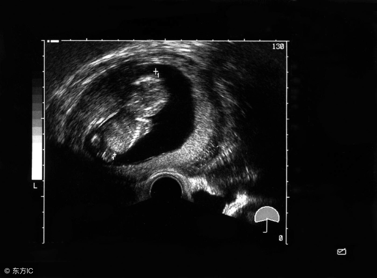 39周胎儿头小腿长正常吗,孕检胎儿头小腿短