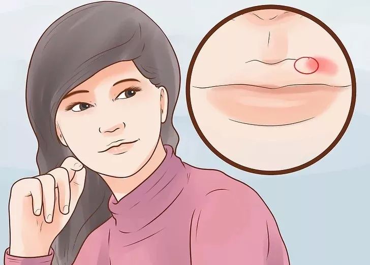 嘴巴上起泡快速消除小窍门,嘴巴上起泡了是怎么回事