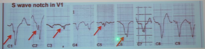 「CHC2018」郭继鸿：心电学进展2018