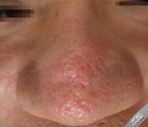 治疗毛孔粗大的护肤品,烟酰胺可以治疗毛孔粗大吗