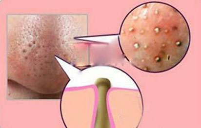 毛孔粗大有螨虫怎么改善,毛孔粗大粉刺闭口毛孔堵塞