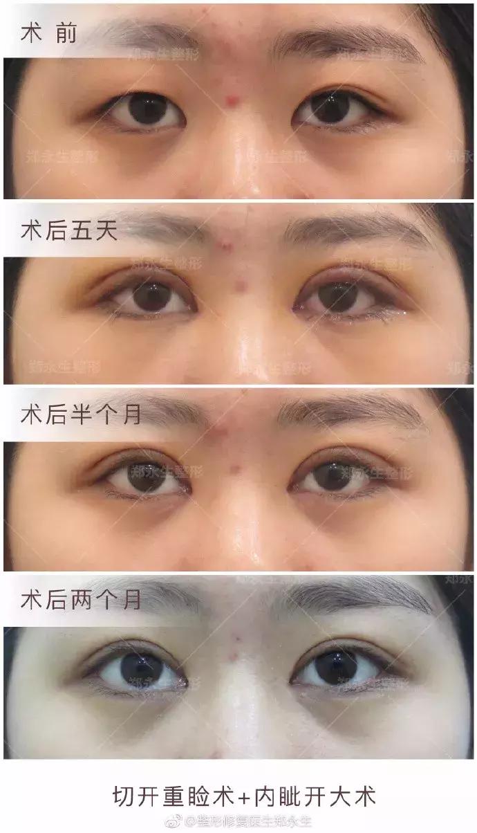 双眼皮刚割完不对称后来好了,全切双眼皮拆线后不对称