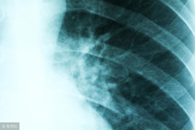 怎样判断支气管扩张的严重程度,支气管扩张ct诊断报告怎么写