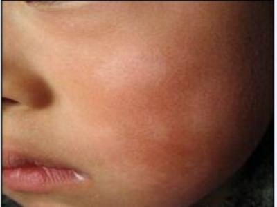 宝宝积食出现积食斑,宝宝积食会长疹子吗