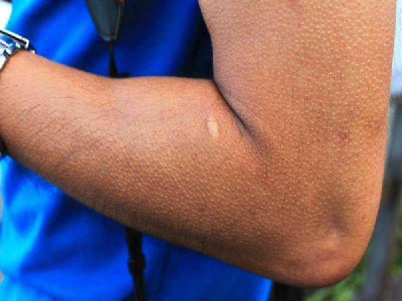 91岁抗战老兵脸上长出“包”,一查竟是皮肤癌！