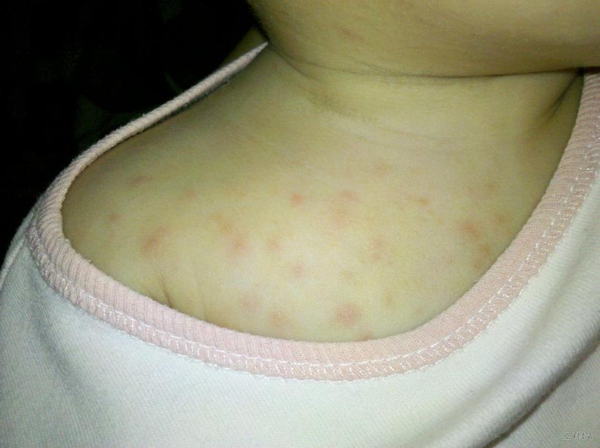 孩子夏天痱子的治疗方法,婴儿长痱子怎么快速消除止痒