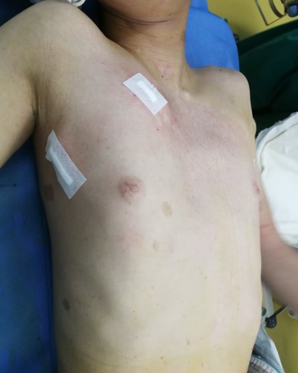 重度漏斗胸手术怎么做,胸廓畸形导致缺氧能做手术吗