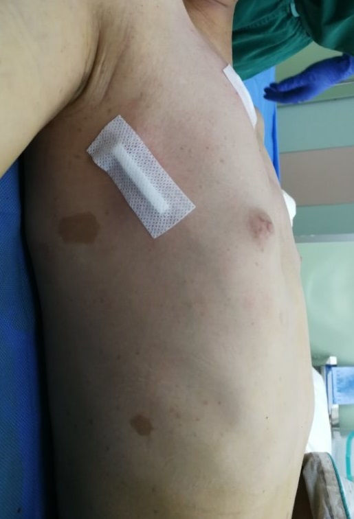 重度漏斗胸手术怎么做,胸廓畸形导致缺氧能做手术吗