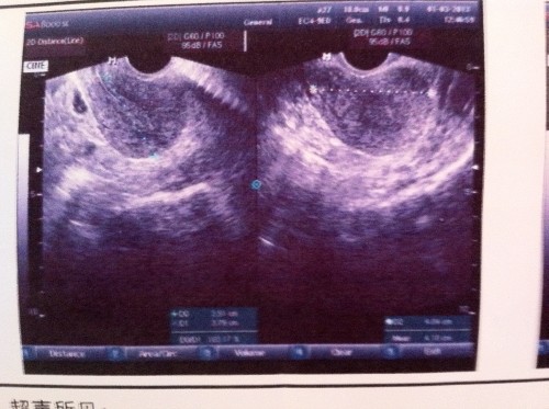 多囊卵巢综合症症状是什么意思,多囊卵巢综合症是什么症状表现