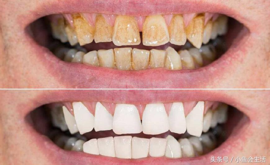 牙科医院牙齿美白的最新方法,去牙科诊所美白牙齿哪种最有效