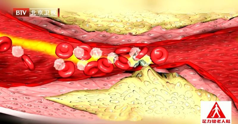 警惕血脂异常的3个信号,血脂异常的十大征兆
